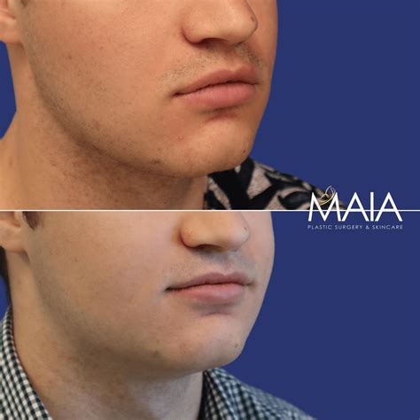 Washington DC Facelift Surgery Before and After Pictures | Tysons Corner
