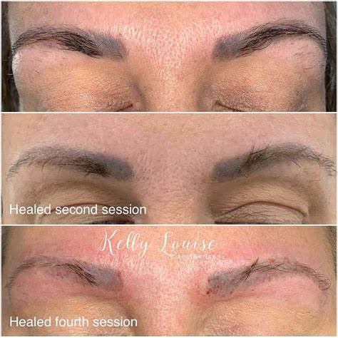 laser eyebrow tattoo removal singapore - Herta Bland