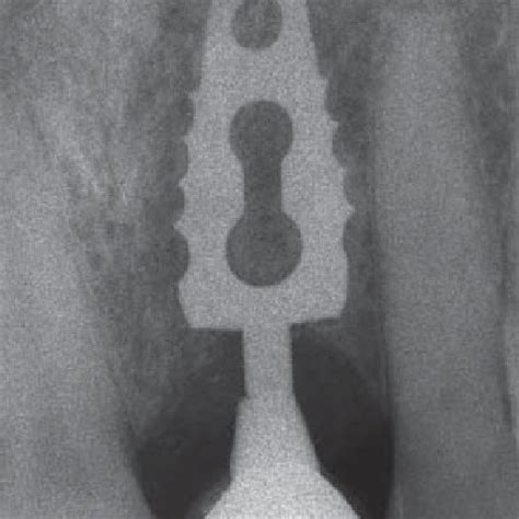 Ramus blade implant currently on the market. | Download Scientific Diagram