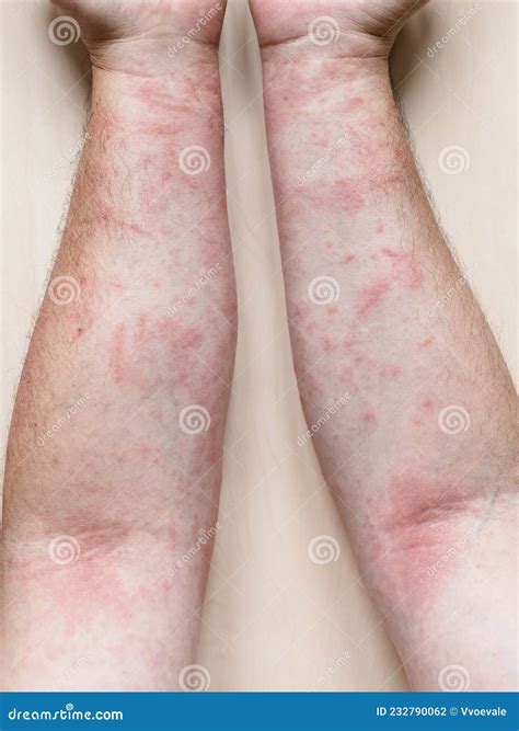 Rash On Forearm