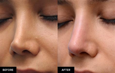 surgical nose job  rhinoplasty   safe mabrie facial