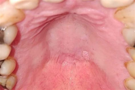 Understanding a Canker Sore vs. Cancer Lesion