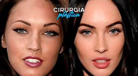 Bichectomia O Que É - Bichectomia: O que é, Valor, Antes e Depois com Fotos em 2025