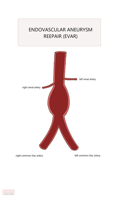 The APDVS Medical Student Curriculum - 4 Abdominal Aortic Aneurysm (AAA)