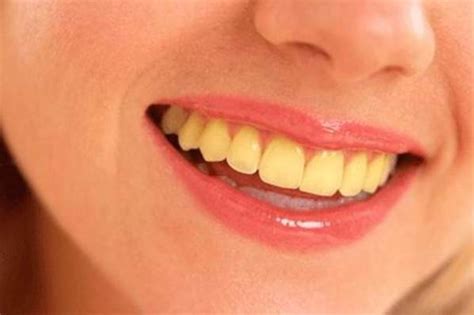 Home Remedies for Yellow Teeth Treatment