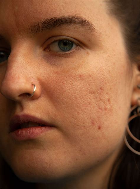 From acne to pigmentation here are the best lasers for every skin