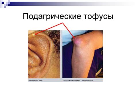 Подагра. Эпидемиология - презентация онлайн