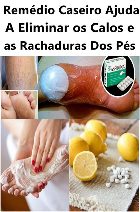 Como Acabar Com Calos Nos Pés - 9