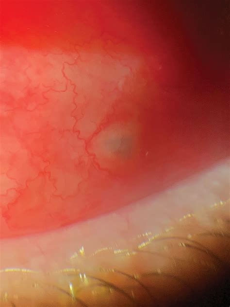 Conjunctival Foreign Body