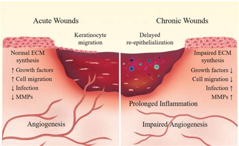 acute  chronic wounds dfw wound care center wound care doctor