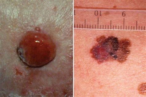 Nodular Malignant Melanoma Skin Lesions