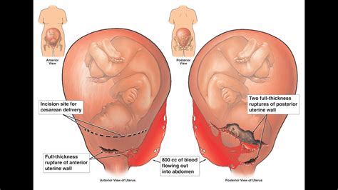 how long to wait to get pregnant after uterine rupture