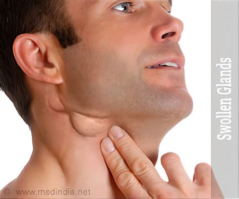 Swollen Lymph Nodes In Neck