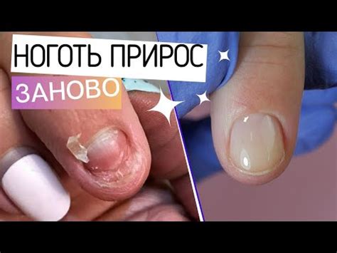 Ноготь ПРИРОС 🥳 Восстановление СОРВАННОГО ногтя. Модный зимний маникюр ...
