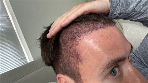 Month 2 Update Post Hair Transplant Istanbul Turkey Cosmedica - YouTube