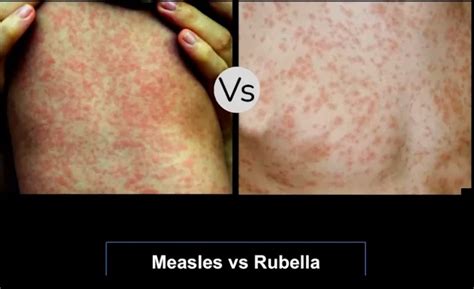 Rubeola Vs Rubella Rash Roseola (Sixth Disease) Symptoms & Causes