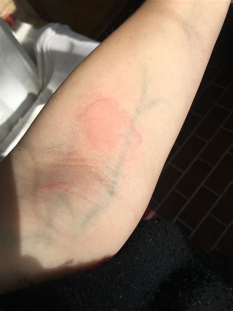 Hair Dye Allergy Patch Test at Sharon Bradley blog