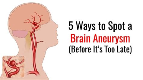 What is the Brain aneurysm? - Chun Dian Bio Technology