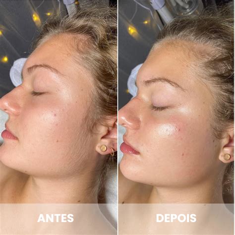 Dermaplaning Para Que Serve