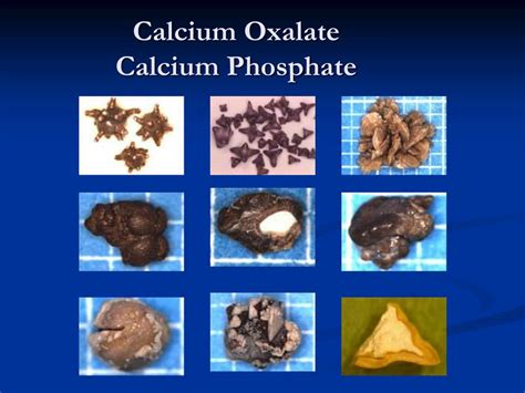 PPT - Kidney Stones (Urolithiasis, Nephrolithiasis) PowerPoint ...