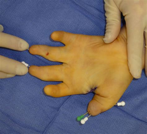 Carpenter Syndrome | Congenital Hand and Arm Differences