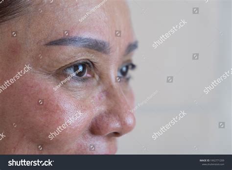 16 Undereye Filler Images, Stock Photos & Vectors | Shutterstock