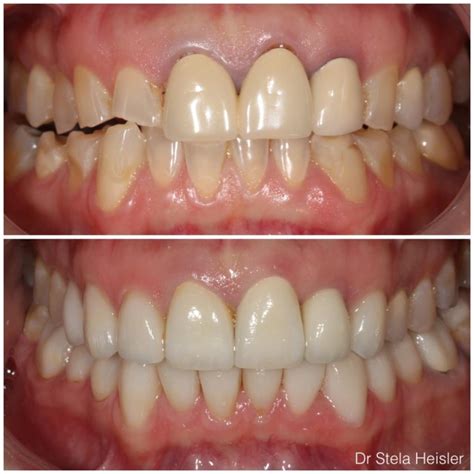 Bruxism: Causes, Symptoms, and Effective Treatment Options | Dr. Stela ...