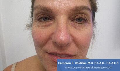 Fraxel Laser Before and After Photos • Dr. Cameron Rokhsar