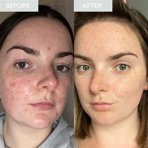 Zinc Products For Oily Skin | Skinician – SKINICIAN