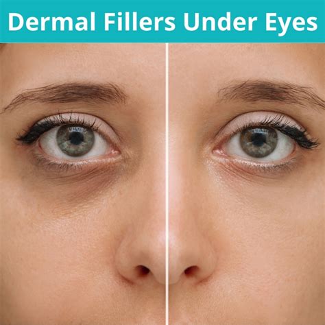 dermal fillers  eyes cost benefits results procedure