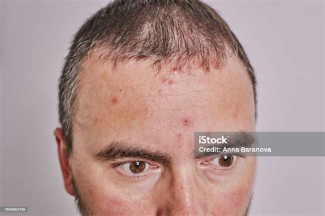 Mans Forehead With Acne Red Spots Skin Disease Stock Photo - Download ...