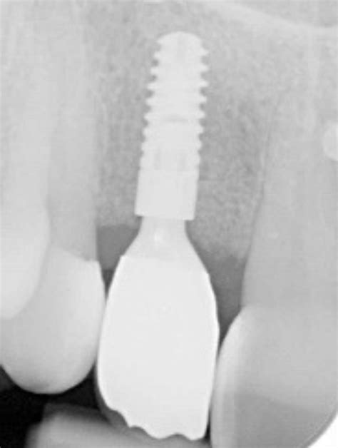 Promoting guided bone regeneration - Dentistry