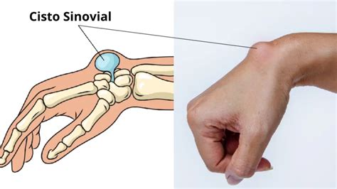 cisto sinovial  pulso sintomas causas  tratamento