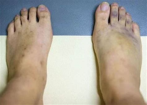 xuat hien nhieu vet bam tren da nhung khong dau canh giac voi  van de