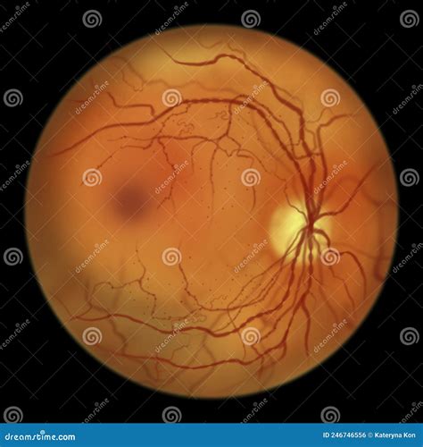 Diabetic Retinopathy, Ophthalmoscopic Diagnosis, Illustration Stock ...