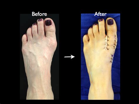 bunion travis  kemp md boise id