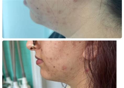 Fat Dissolving Injections - Astra Medicare