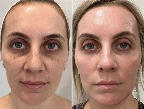 laser facial good  bad  paul bravo blog