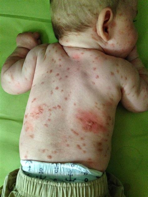 Pin on Mastocytosis