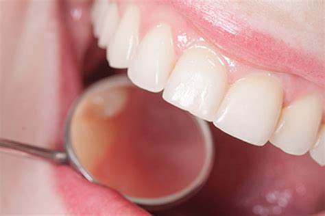 How a Periodontist Uses Scaling and Root Planing to Treat Gum Disease