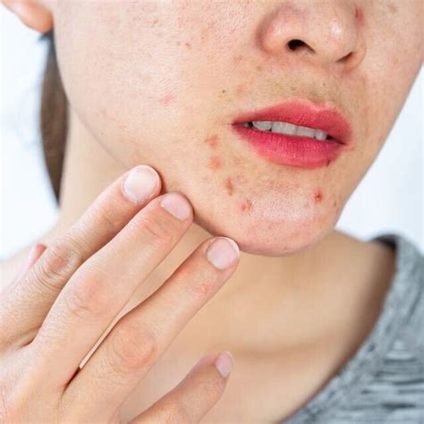 Zapping the Zits: What to do about Acne? | Truyou Appearance Medicine