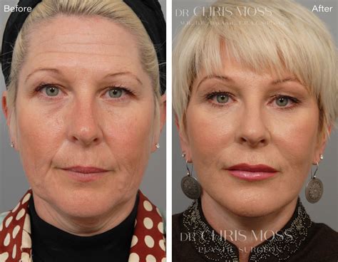 facelift surgery  melbourne  dr chris moss including smas