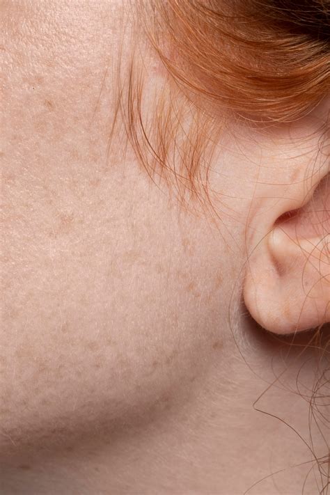 acne scars singapore acne scar removal treatments ids clinic