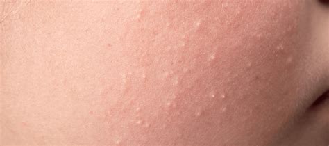 understanding small bumps  face  acne