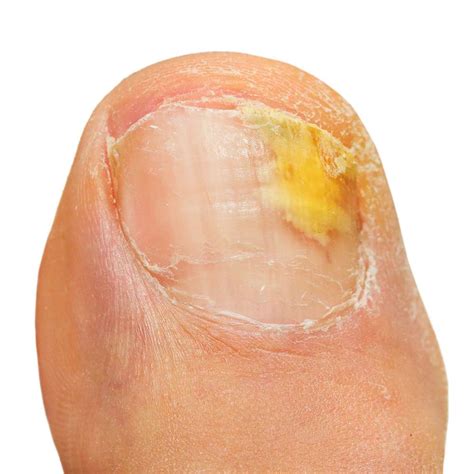 distal subungual onychomycosis home remedies