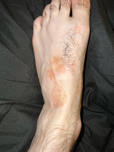 Patch of discoloration on foot : r/DermatologyQuestions
