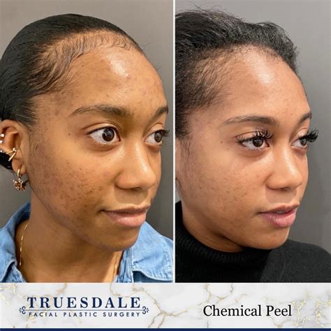 chemical peels beverly hills truesdale facial plastic surgery