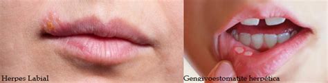 Herpes Não Tem Cura - Herpes labial – ObservaPed