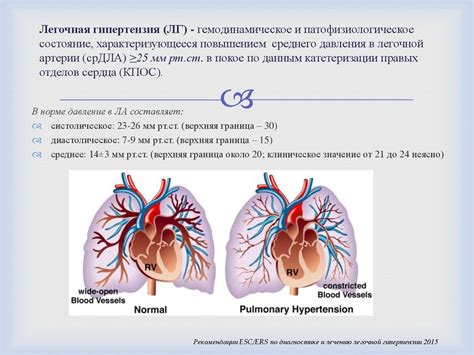 Диагностика лёгочной гипертензии - презентация онлайн