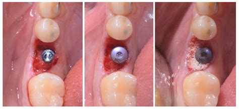 delayed implant placement  patients  tooth